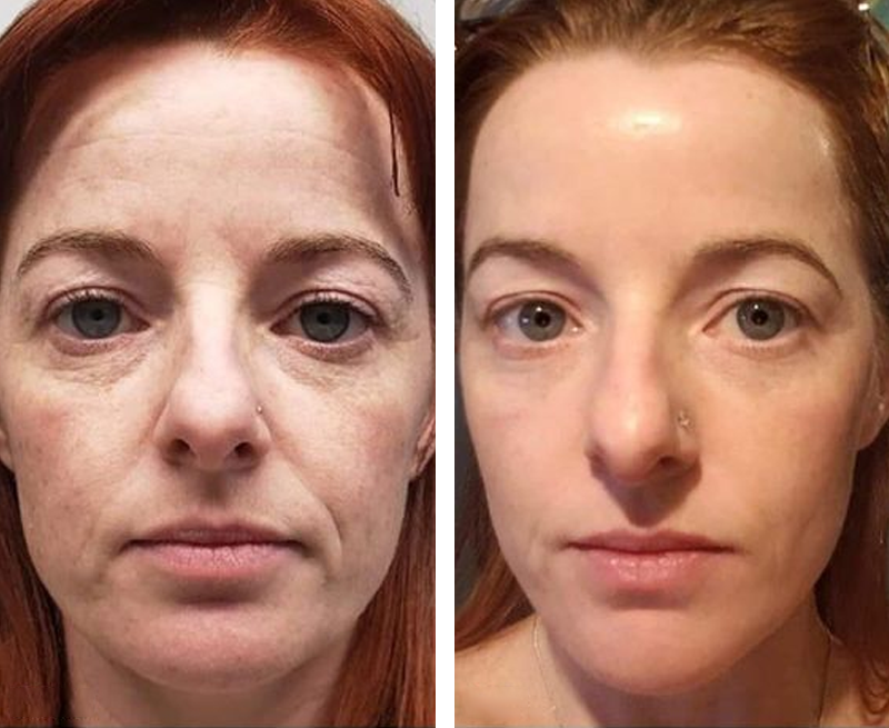 โจ๐๐๐ฌ๐ญ ๐๐๐ฒ ๐๐ข๐ฌ๐๐จ๐ฎ๐ง๐ญ: 87% ๐๐
๐
๐ธ Instant Wrinkle Eraser: Restore Skin Elasticityโญ