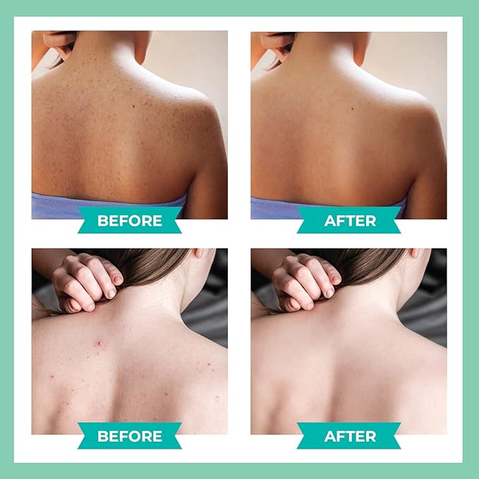 😍 😍 LuxeLife™ Back Acne Treatment Spray
