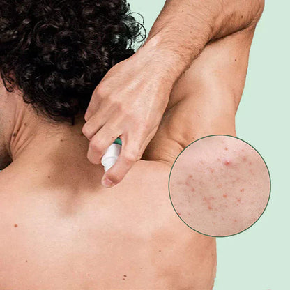 😍 😍 LuxeLife™ Back Acne Treatment Spray