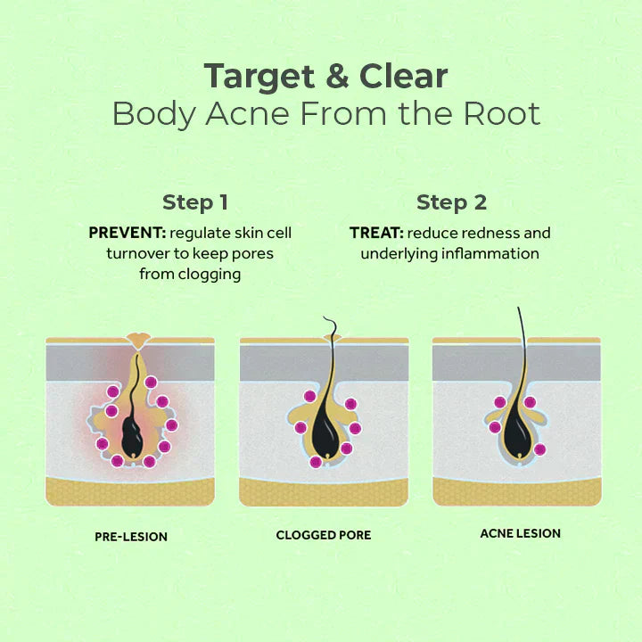 😍 😍 LuxeLife™ Back Acne Treatment Spray