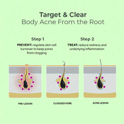 😍 😍 LuxeLife™ Back Acne Treatment Spray