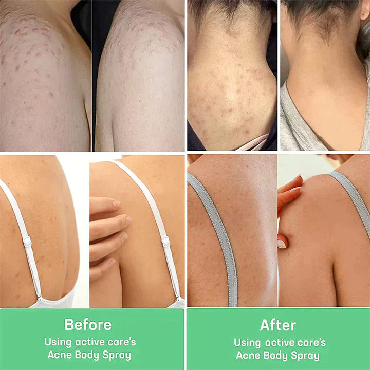 😍 😍 LuxeLife™ Back Acne Treatment Spray