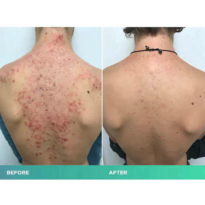 😍 😍 LuxeLife™ Back Acne Treatment Spray