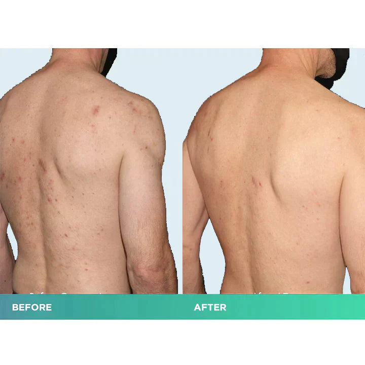 😍 😍 LuxeLife™ Back Acne Treatment Spray