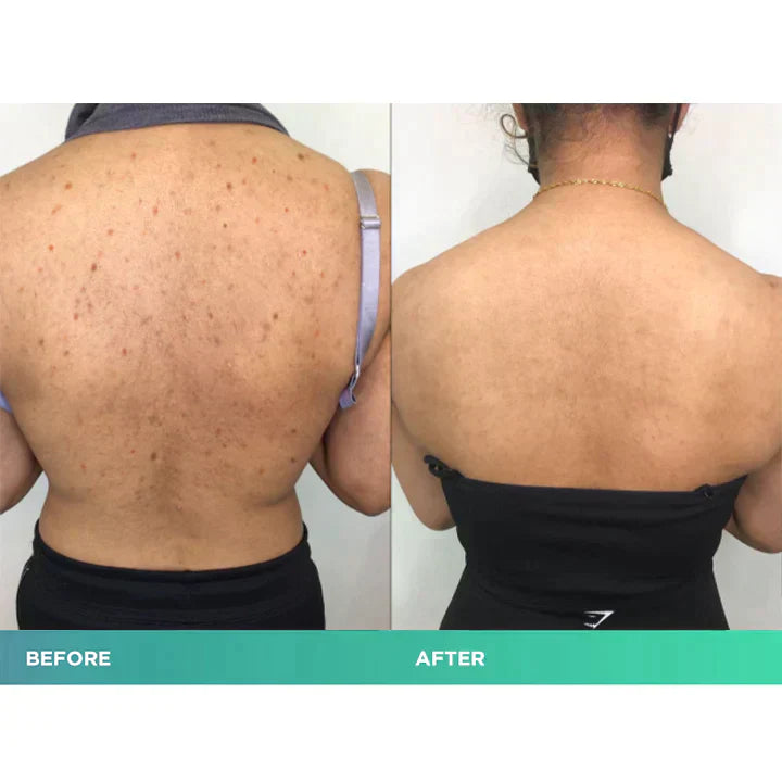 😍 😍 LuxeLife™ Back Acne Treatment Spray